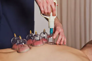 Hijama-Cupping-Therapy-.webp